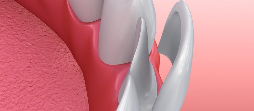 porcelain veneers charlotte nc