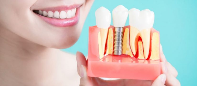 Dental Implants: The Next Best Thing to Natural Teeth